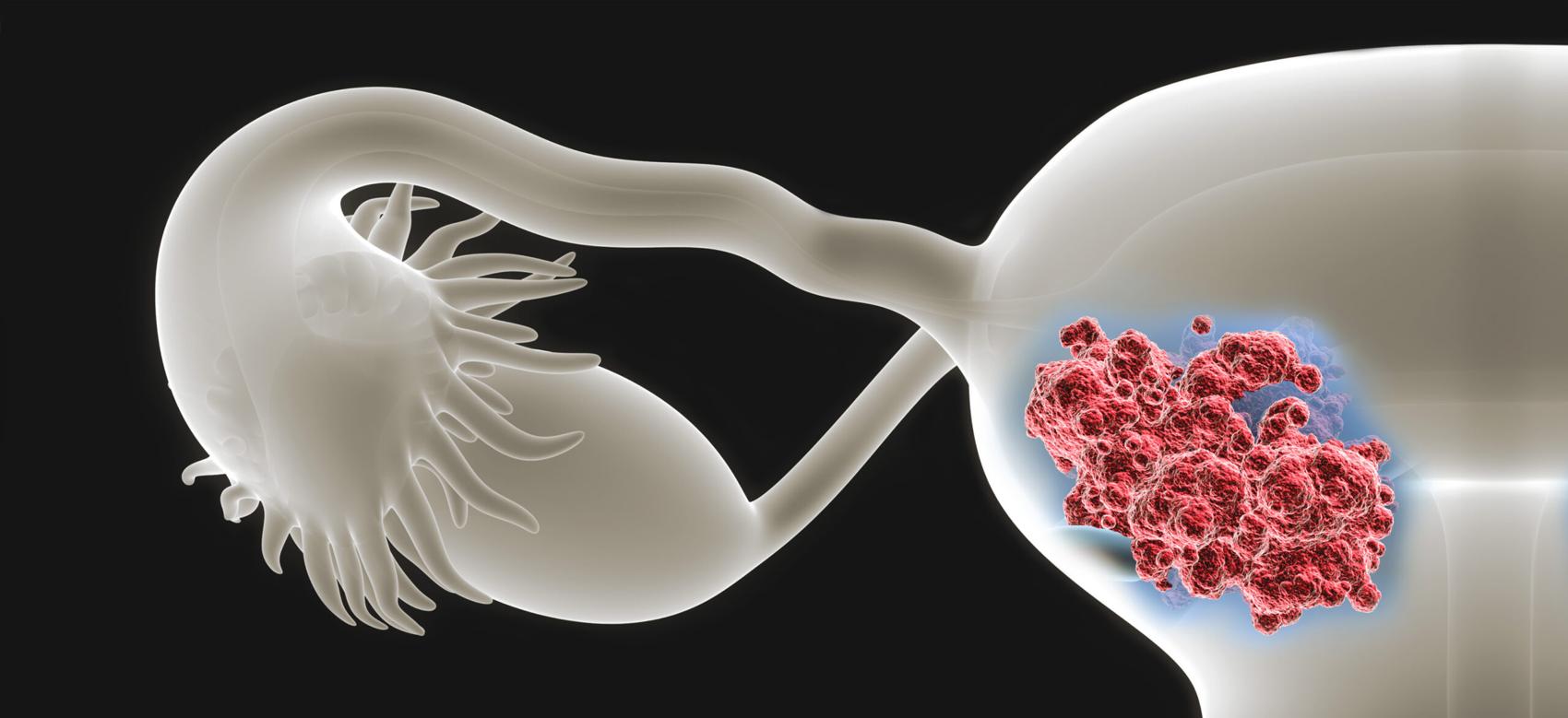 Perspective x-ray view of human uterus with endometrial cancer
